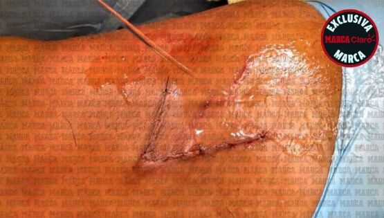 Así fue la Reconstrucción del Cuádriceps de Giovani dos Santos